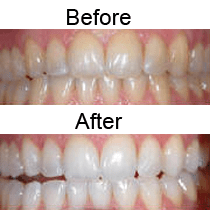 Before and After teeth