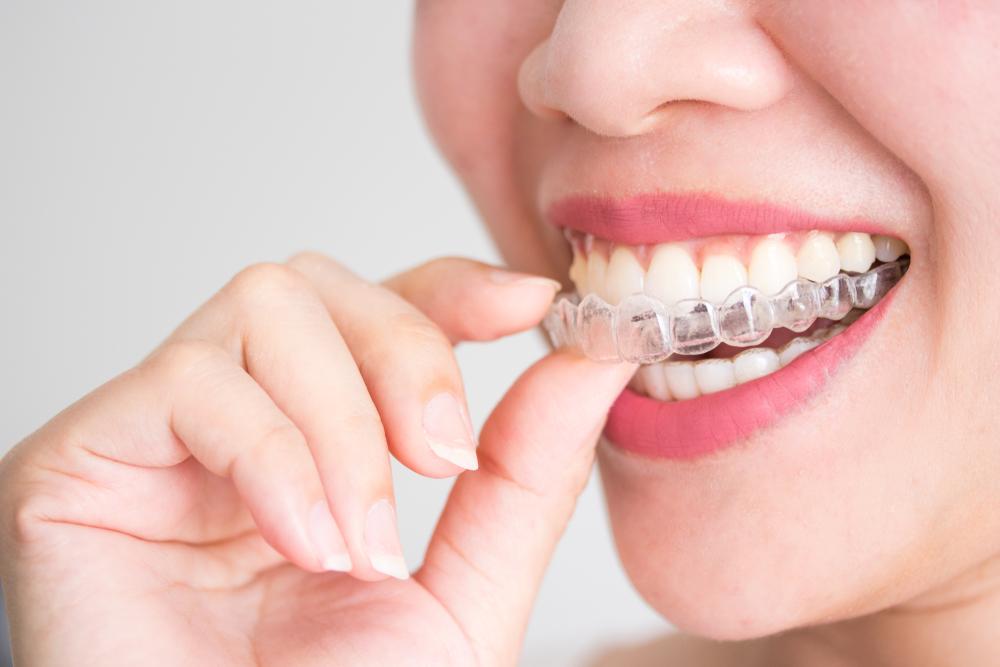 Woman fitting Invisalign over teeth - Blythe Road Dental Practice