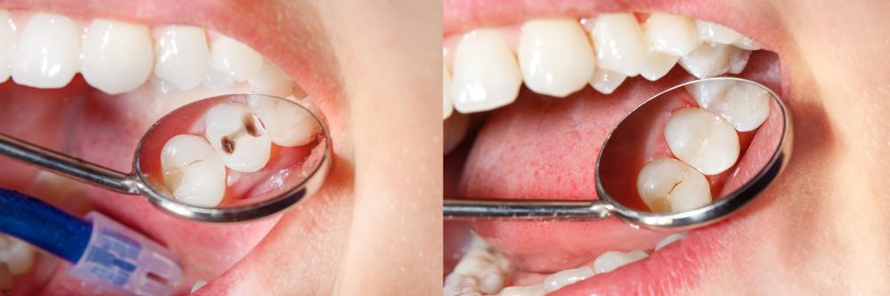 Composite Fillings - All You Need to Know - Blythe Road Dental Practice