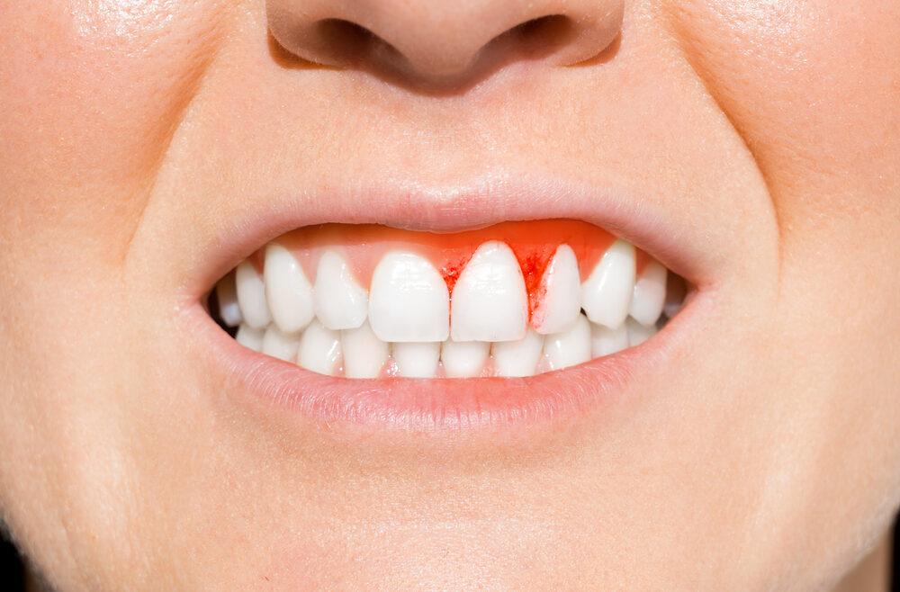 Periodontitis and gingivitis taken seriously - Blythe Road Dental Practice